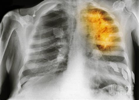 How common are lung nodules? Lung Cancer, X-ray Photograph by Spl