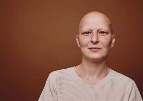 Alopecia Blog Hair Heals Organisation