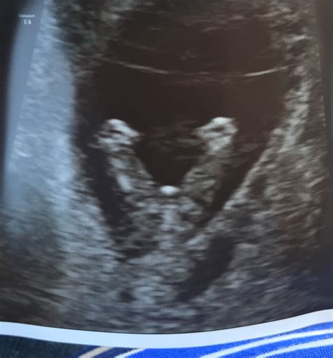 Boy Or Girl 12 Week Ultrasound — The Bump