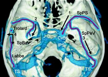 We did not find results for: Normal Anatomy of Intracranial Veins: Demonstration with ...