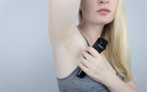 Underarm Pimples Stock Photos Pictures And Royalty Free Images Istock