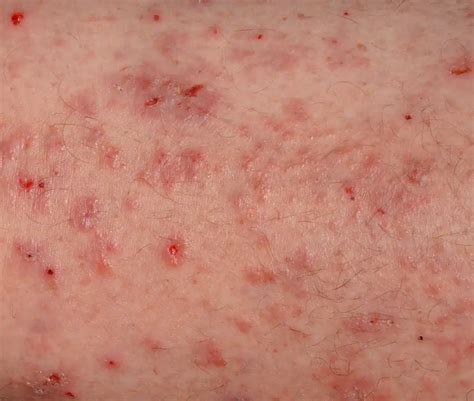 The Scabies Rash And Other Scabies Symptoms To Watch For Riverchase Dermatology