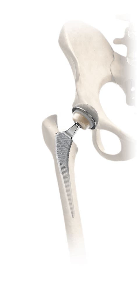 Understanding Total Hip Replacement Microport Orthopedics