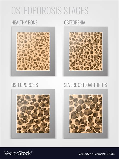 Osteoporosis Stages Image Royalty Free Vector Image