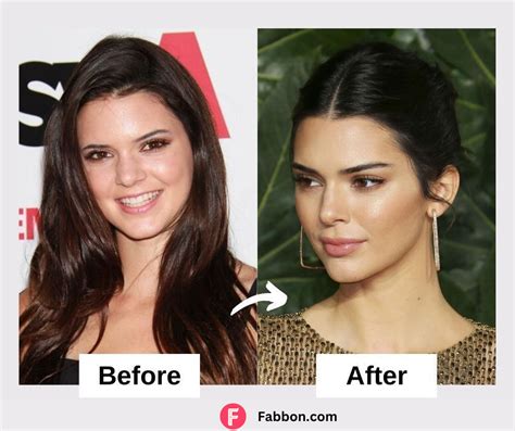 Revealed Kendall Jenner Plastic Surgery Secrets Before And After