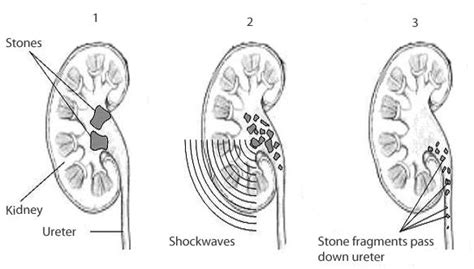 Shockwave Treatment For Kidney Stones Dr Dinesh Patel