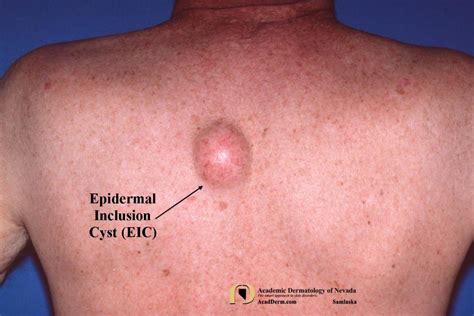 Epidermoid Cyst On Back