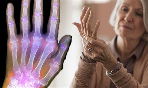 Arthritis Treatment Do These Six Hand Exercises To Relieve The Painful