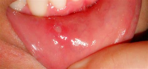 Best Dental Care Mouth Ulcer Treatment Medicine In Kalyannagar