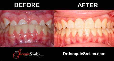 Invisalign Before And After Photos Of Nyc Patients