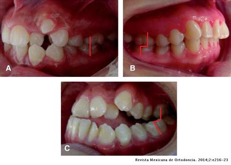 prevalence of malocclusions associated with pernicious oral habits in a mexican sample revista