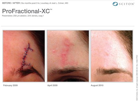 New Sciton Laser Scar Revision Treatment Aya Medical Spa