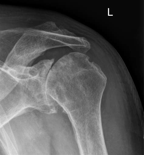 Glenohumeral Joint Rheumatoid Arthritis Radiology Case