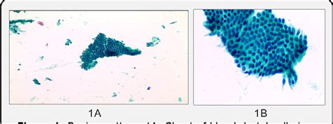 Pdf Bile Duct Brush Cytology Challenges Limitations And Ancillary