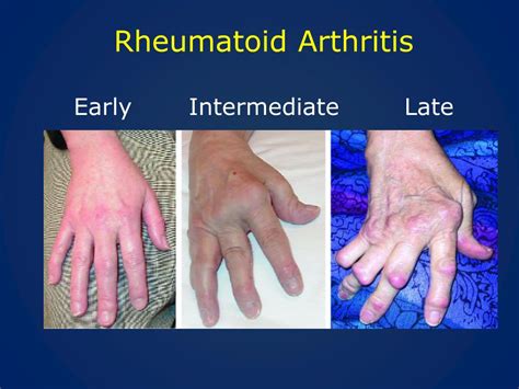 Ppt Rheumatoid Arthritis Update Powerpoint Presentation Free
