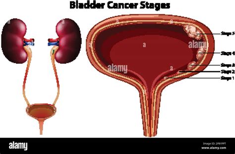 Bladder Cancer Stages Vector Illustration Stock Vector Image And Art Alamy