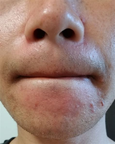 Fungal acne is an entirely different beast next to regular acne, so we're here to show you how to identify it and ways to help heal it. Is this fungal acne? - General acne discussion - Acne.org