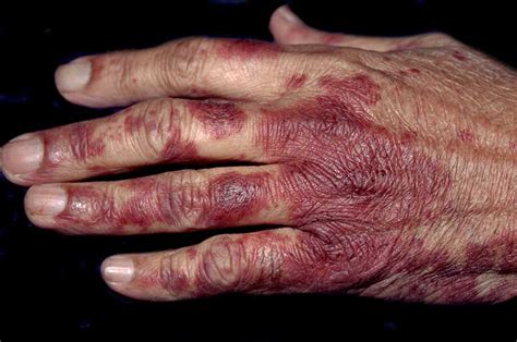 Chemotherapy Induced Acral Erythema