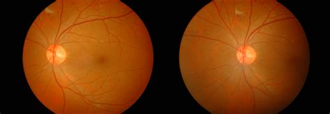 Fundus Photo Revision E Module Diabetic Retinopathy Screening Course