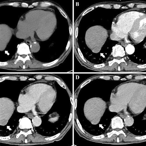 Figure3dynamic Ct Findings Of The Tumor In 2017 The Tumor Was