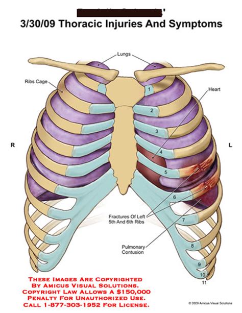 True ribs (proper ribs) are directly connected to the sternum through their. Thoracic Injuries and Symptoms