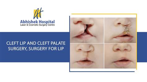 Cleft Lip And Cleft Palate Surgery Surgery For Lip In Hindi Youtube