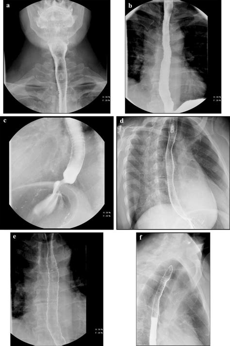 Examples Of Ringed Esophagus Or Trachealization A Front Double
