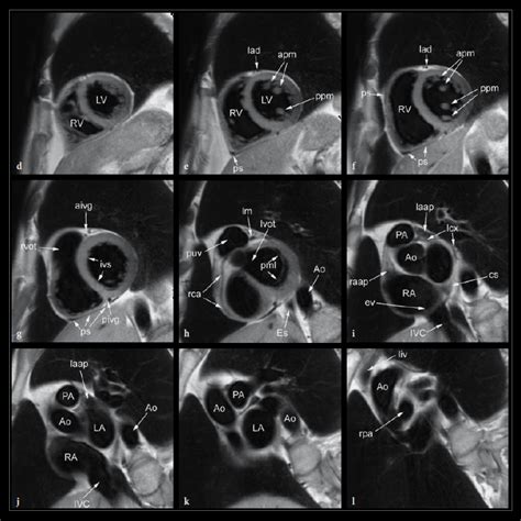 Mri Of The Elbow Detailed Anatomy W Radiology 653