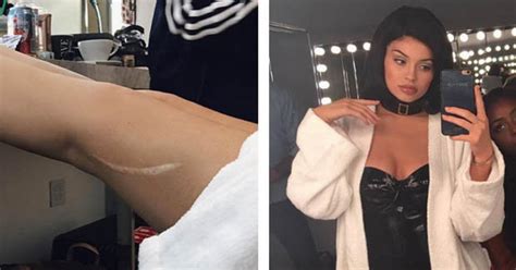 Kylie Jenner Reveals Shocking Scar From When She Was Impaled On A Fence Daily Star