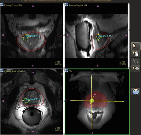 Prostate Mri Fusion Biopsy Procedure