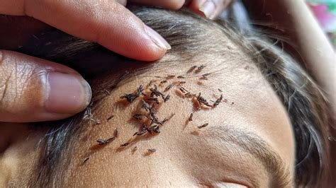 Removing All Head Lice Getting All Head Lice Out Youtube