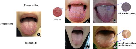 A Normal Tongue Is Shown As Pale Red Tongue And Thin White Coating