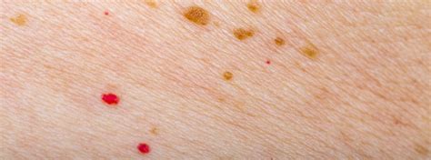 Red Dots On Skin Causes Of Red Dots On Skin World Pulse