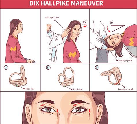 Dix Hallpike Maneuver Diagnosis And Treatment