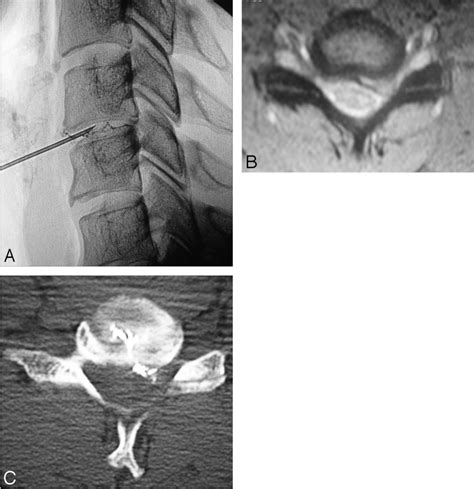 Figure 1 From Percutaneous Treatment Of Cervical Disk Hernias Using