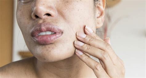 9 Symptoms Of Lupus Women Should Know About