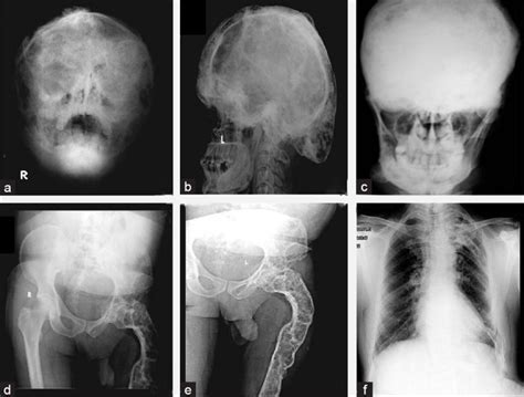 Conventional Radiography A X Ray Pns Face Showing Widening Of The