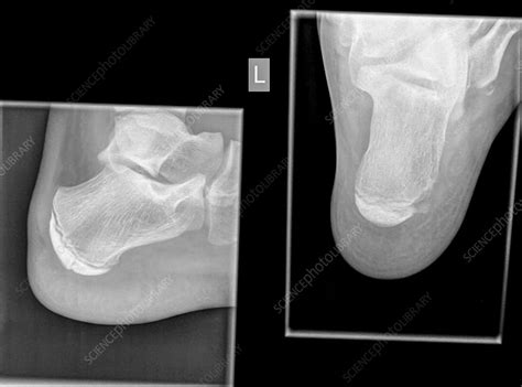 Calcaneus Heel Bone X Ray Stock Image C0197324 Science Photo