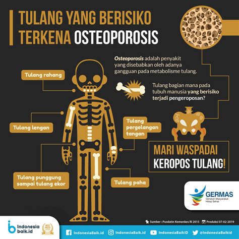 Tulang Yang Berisiko Terkena Osteoporosis Indonesia Baik