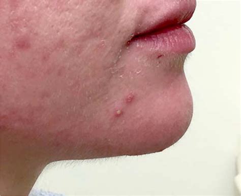 acne vulgaris diagnosis and treatment aafp