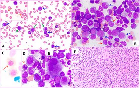 Morphologic Findings In Peripheral Blood And Bone Marrow Peripheral