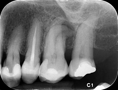 Chronic Apical Periodontitis Kitsilano Endodontics