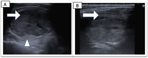 Thyroid Ultrasound For Patient 5 A 66 Year Old Female With An