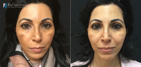 Melasma Laser Treatment For Woman Whose Melasma Was Made Worse By