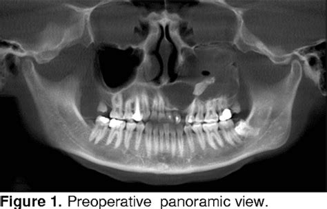 Figure 1 From Dentigerous Cyst With An Impacted Canine Case Report