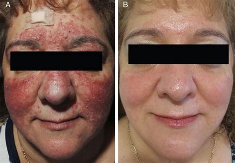 Papulopustular Rosacea Response To Treatment With Oral Azithromycin
