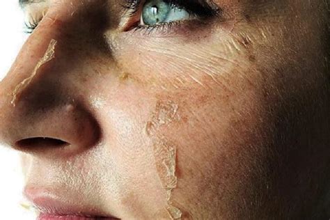 Flaky Skin What You Need To Do For Dry Flaky Skin On Your Face