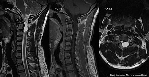 Dr Balaji Anvekar Frcr Retrodental Cervical Synovial Cyst Mri