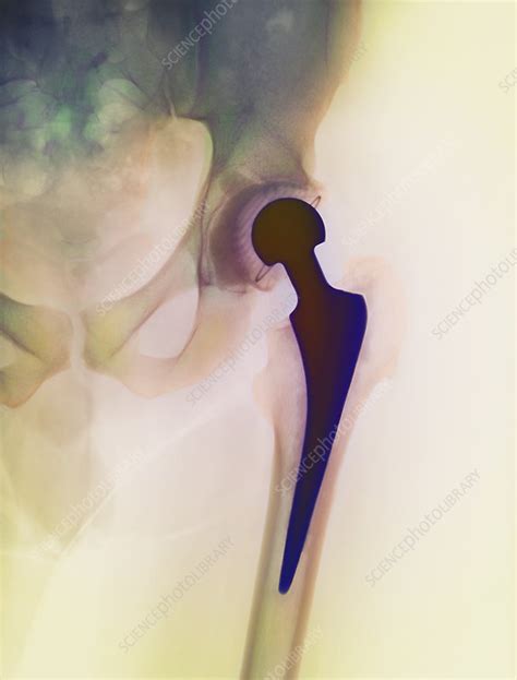 Loosened Hip Replacement X Ray Stock Image M6000234 Science