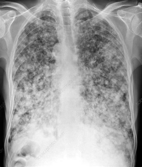 Secondary Lung Cancers X Ray Stock Image C0154606 Science Photo